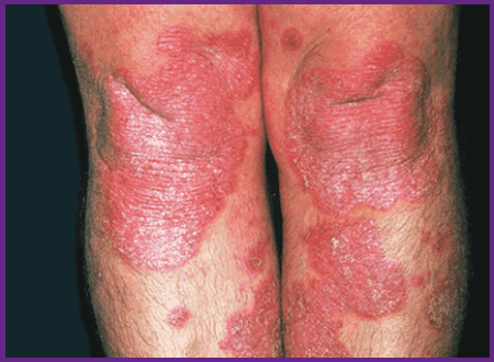 Plaque Psoriasis