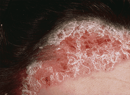 Scalp Psoriasis