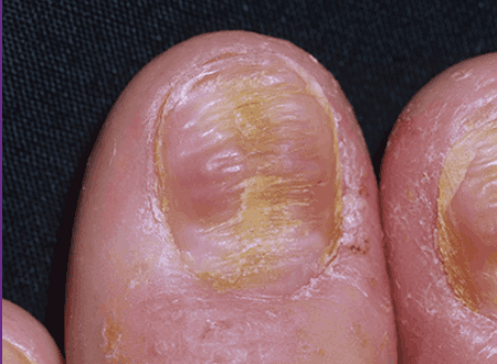 Nail Psoriasis