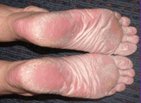 Palmoplantar Psoriasis