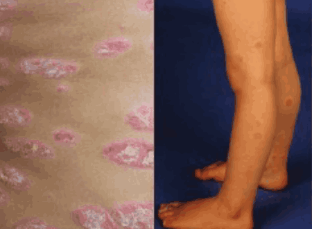 Paediatric Psoriasis